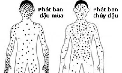 Small pox va Chicken pox
Small pox: Bong nuoc TO va nhieu, hoa MU , cung
Chicken pox: Bong