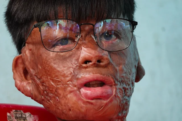 Vu Lan tháng 7: Cậu bé miền Tây dũng cảm quay lại cứu mẹ nuôi, bỏng 96% cơ thể
Tai nạn kin