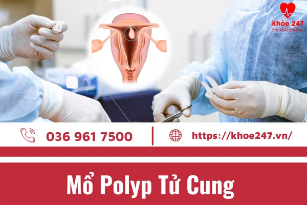 Mổ Polyp tử cung: Các phương pháp mổ, Khả năng mang thai, Chi phí…
 Mổ Polyp Tử Cung là ph