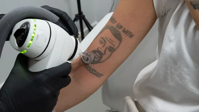🔥 This tattoo removal studio will laser off your Kanye West tattoo for free 🔥
----------